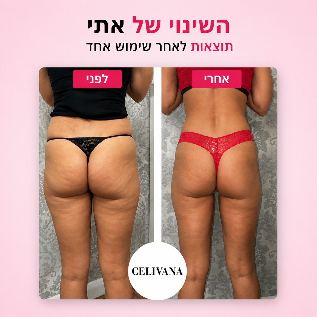 מכשיר עיסוי להקלה בצלוליטיס ועור עודף